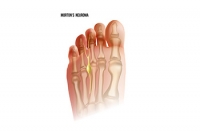 Treatment of Morton’s Neuroma