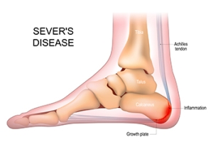 Sever&#039;s Disease in Growing Children