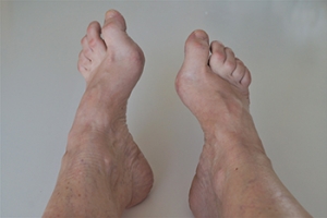 Symptoms and Treatment of High Arch Pain