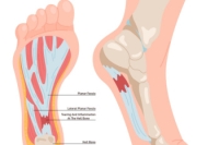 Plantar Fasciitis and Common Risk Factors