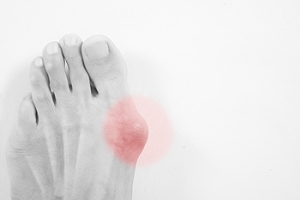 What are Bunions?