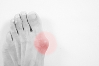 What are Bunions?