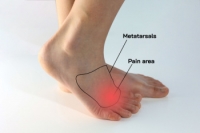 Symptoms of Morton’s Neuroma