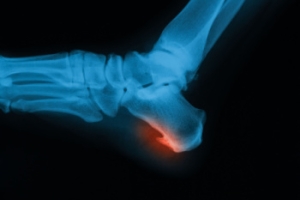 What Causes Heel Spurs?