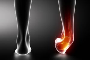 Healing a Broken Ankle Starts With Walking Sooner