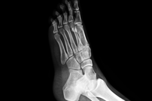 Causes and Risks of Foot Stress Fractures