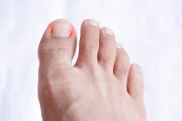 Tips for Preventing Ingrown Toenails
